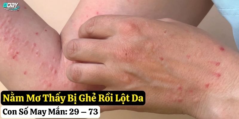 nằm mơ thấy bị ghẻ