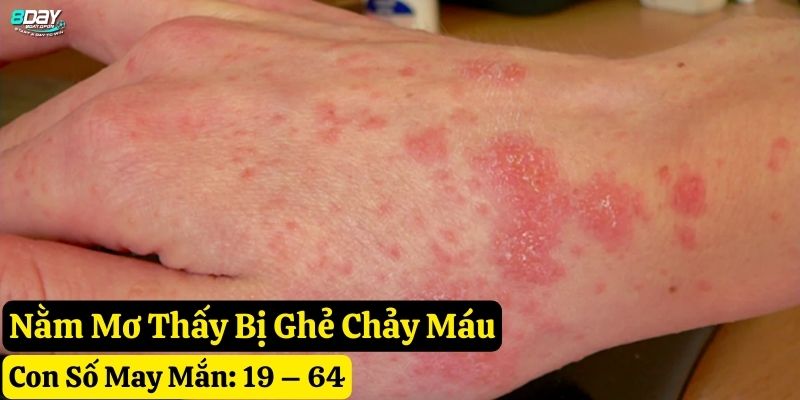nằm mơ thấy bị ghẻ 8day